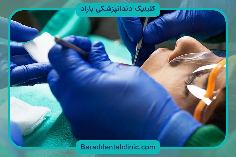 پرکردن از انواع بازسازی دندان 