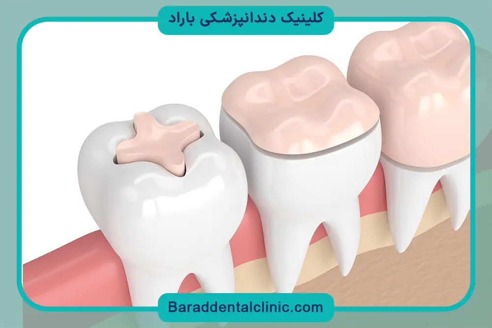 ترمیم و بازسازی دندان چیست؟