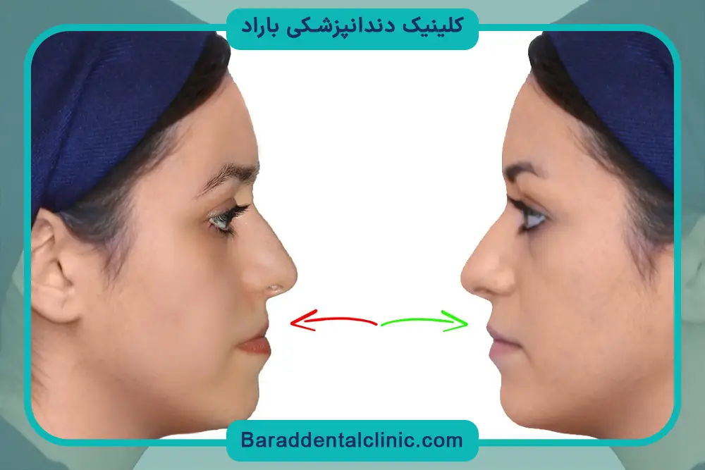 عوامل موثر بر قیمت سیم کشی دندان فک پایین 