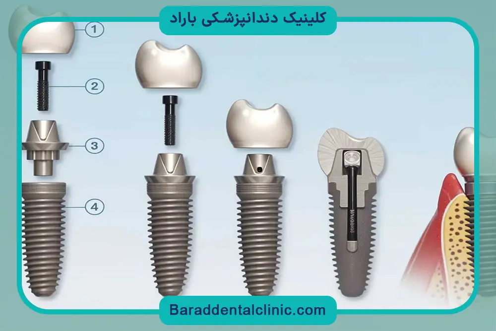 ایمپلنت دندان بدون جراحی چیست؟ 
