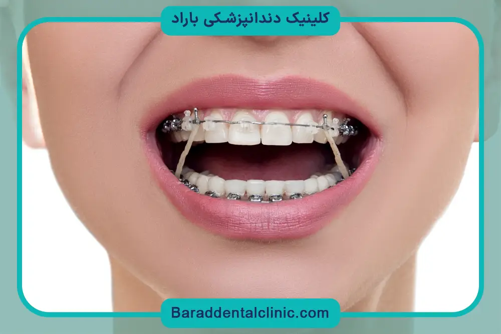 سیم کشی دندان تا چند سال طول میکشد؟ بررسی کلی