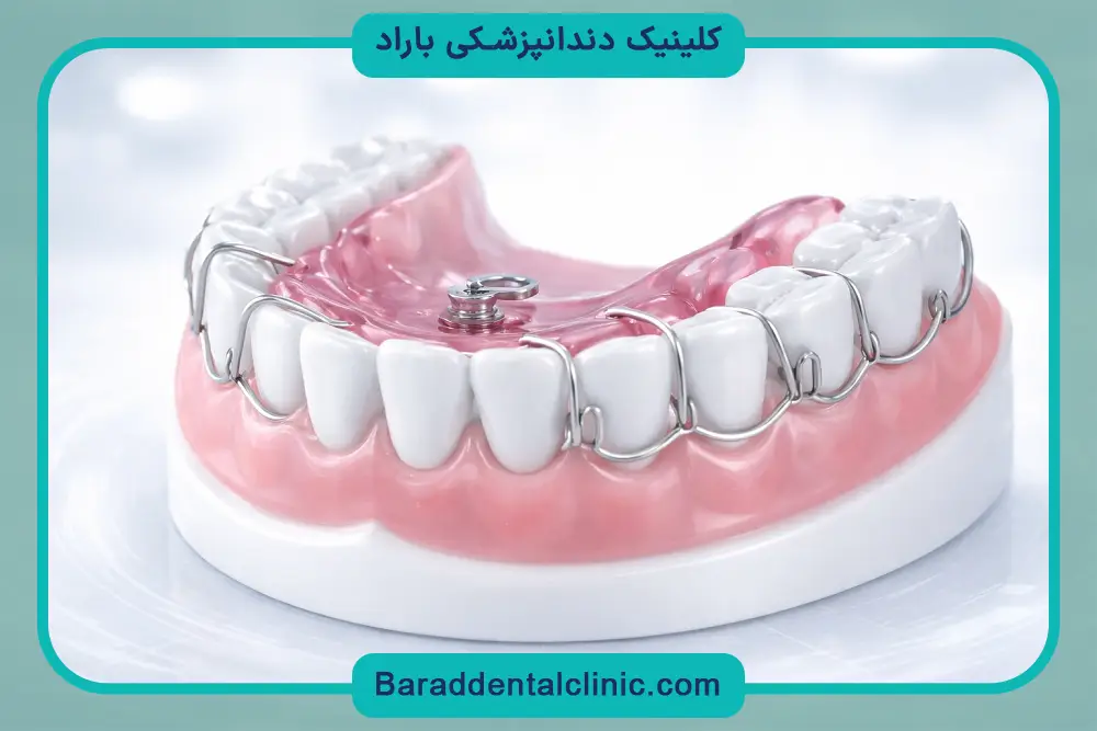 براکت متحرک دندان چیست؟