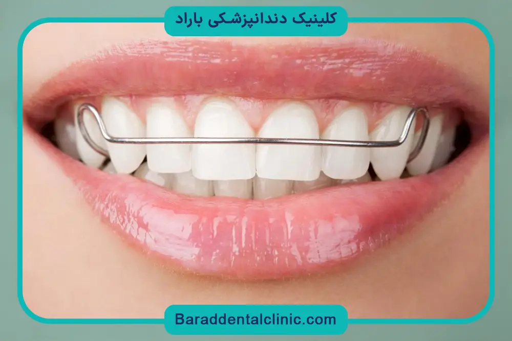 براکت دندان نهفته چیست؟