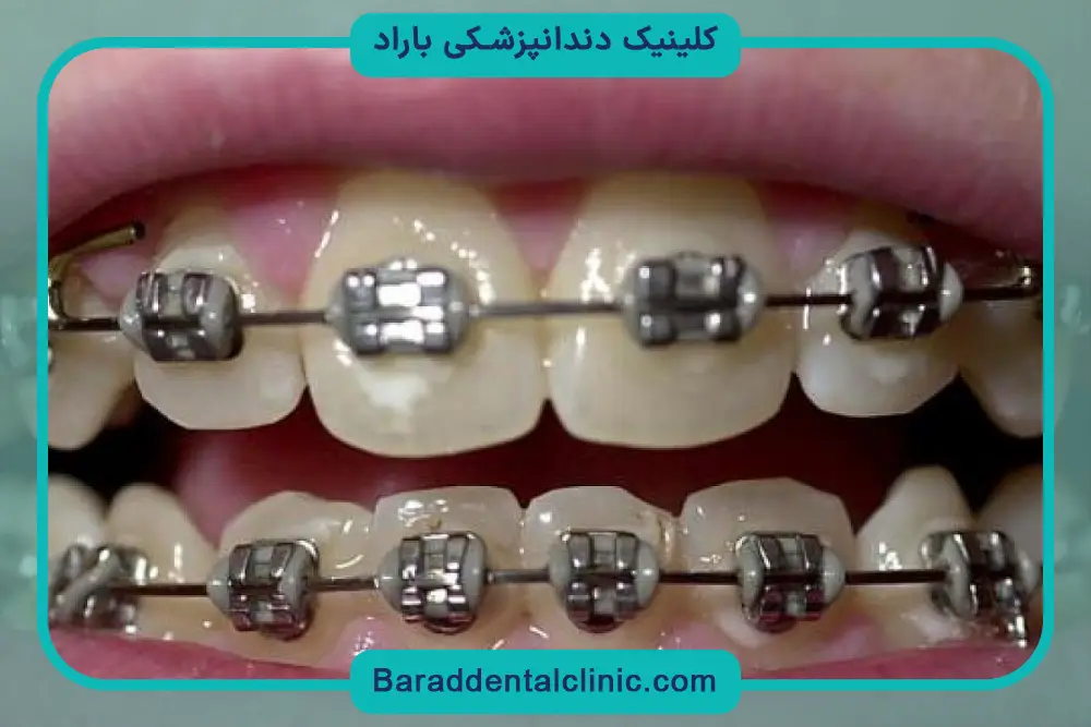 بررسی قیمت سیم کشی دندان پایین 