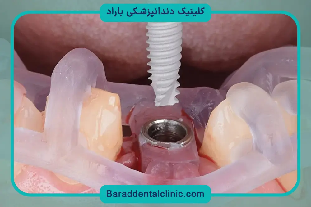 مزایای ایمپلنت دیجیتال در تهران 
