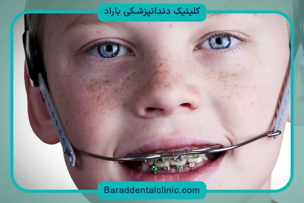 اطلاعات عکس سیم کشی دندان پسرانه 
