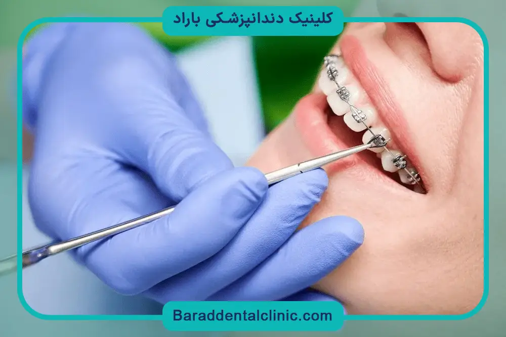 براکت گذاری دندان چیست؟