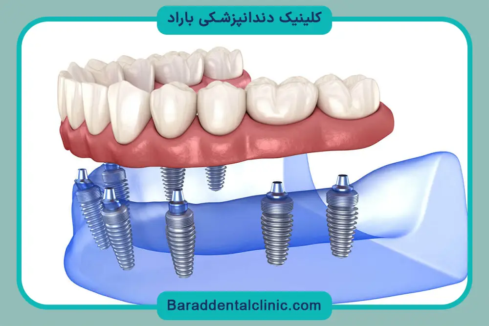 مدیریت هزینه ایمپلنت دیجیتال ارزان