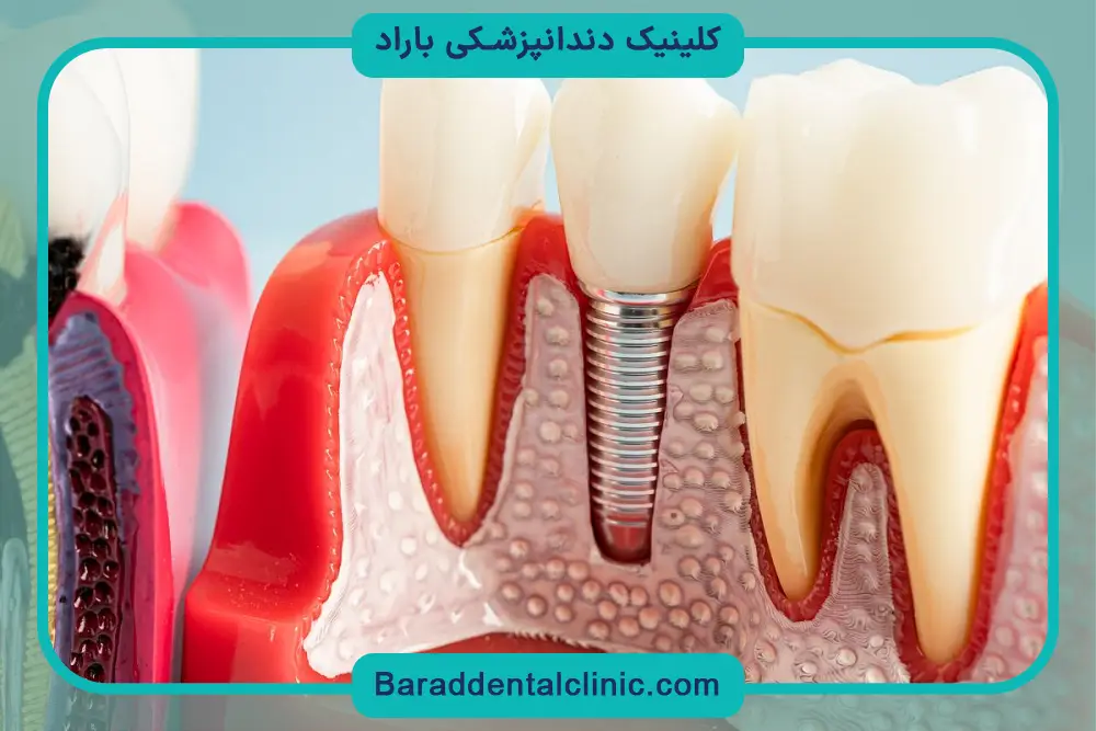 انتخاب متخصص ایمپلنت دیجیتال پاسداران 