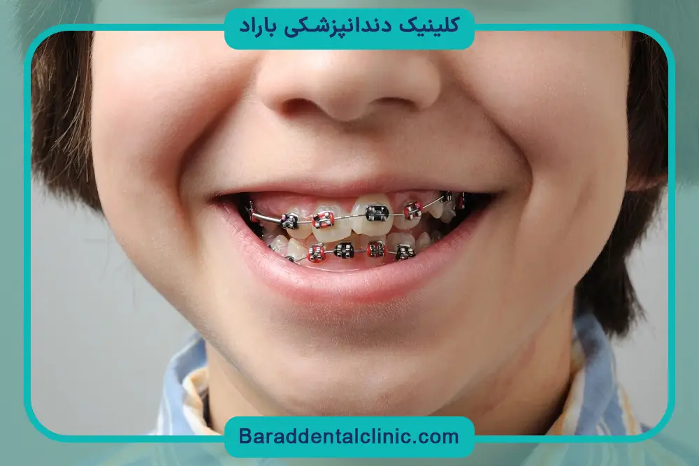 قیمت پایه سیم کشی دندان پسرانه 