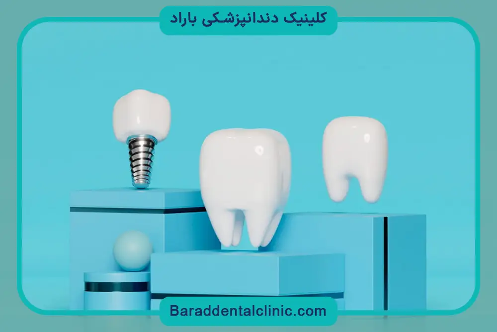 مزایای ایمپلنت دیجیتال تهران