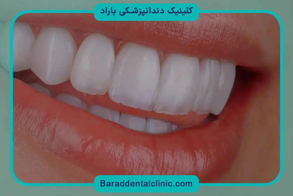 برندهای آمریکایی، بهترین مارک کامپوزیت ونیر دندان 