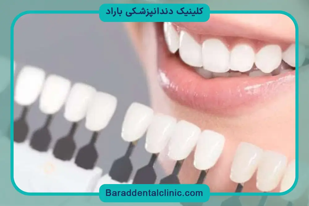 هزینه کامپوزیت تهران
