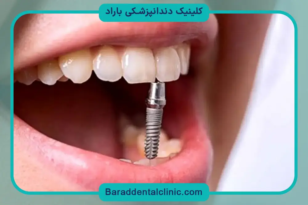 تفاوت هزینه بازسازی دندان جلو و عقب