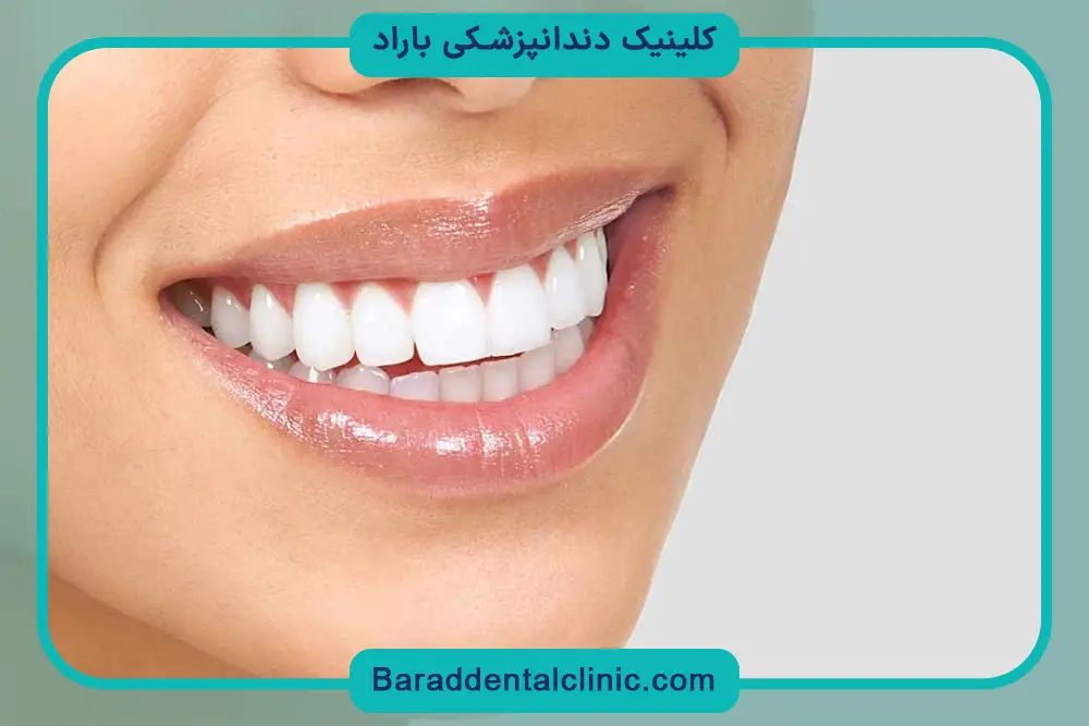 لمینت از انواع بازسازی دندان 