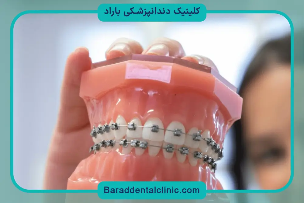 تفاوت قیمت سیم کشی دندان فک پایین و بالا