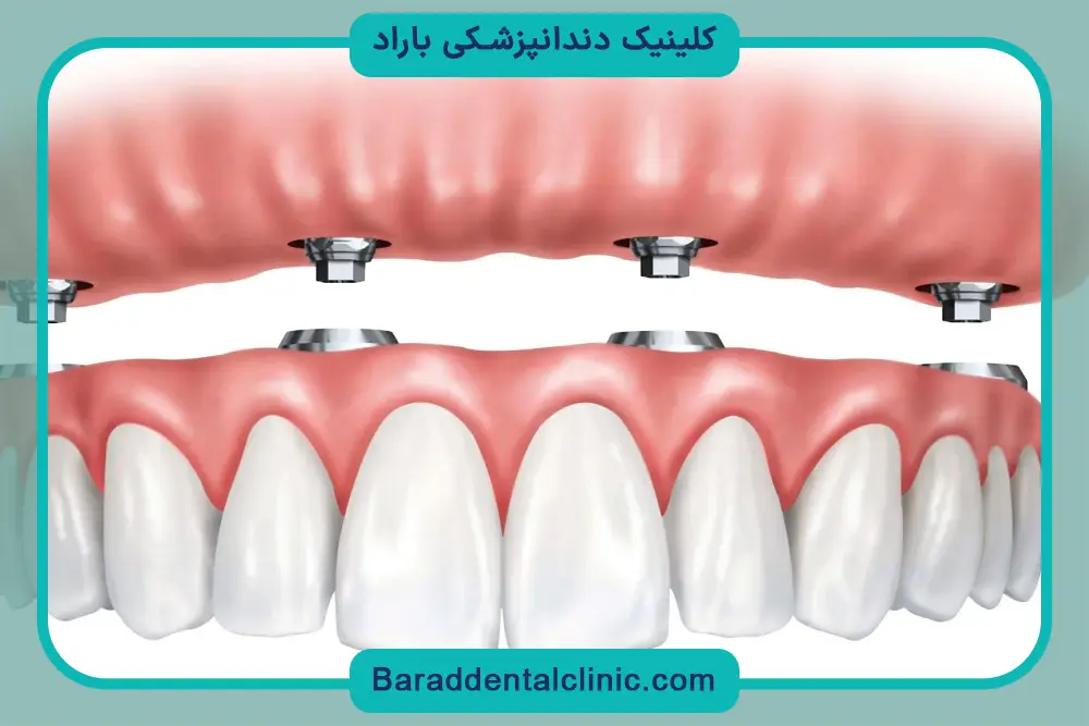 مزایای ایمپلنت دندان بدون جراحی 