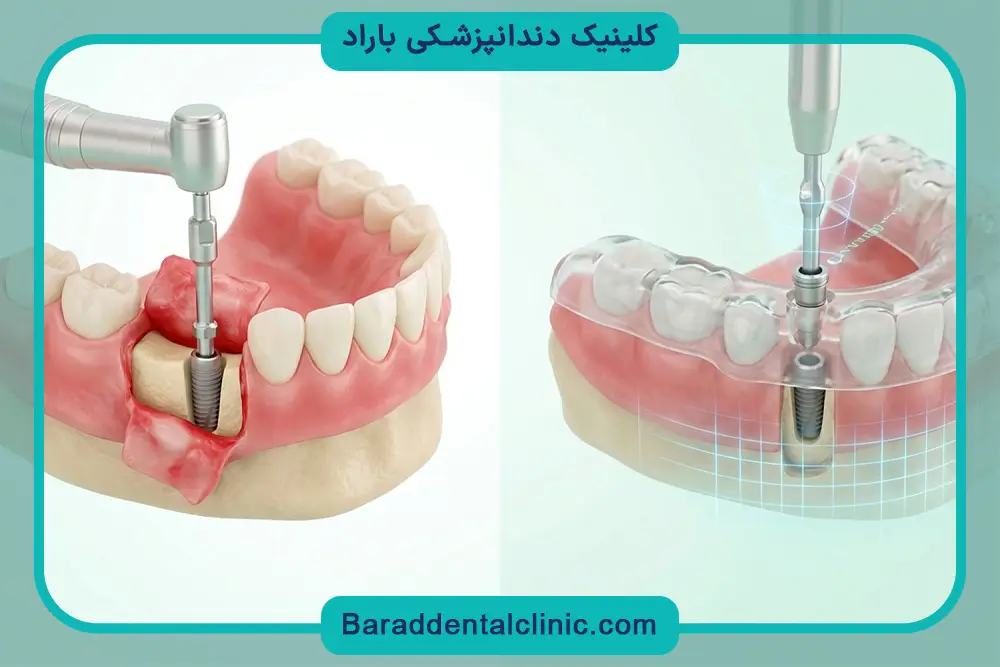 مراحل ایمپلنت دیجیتال بدون جراحی 