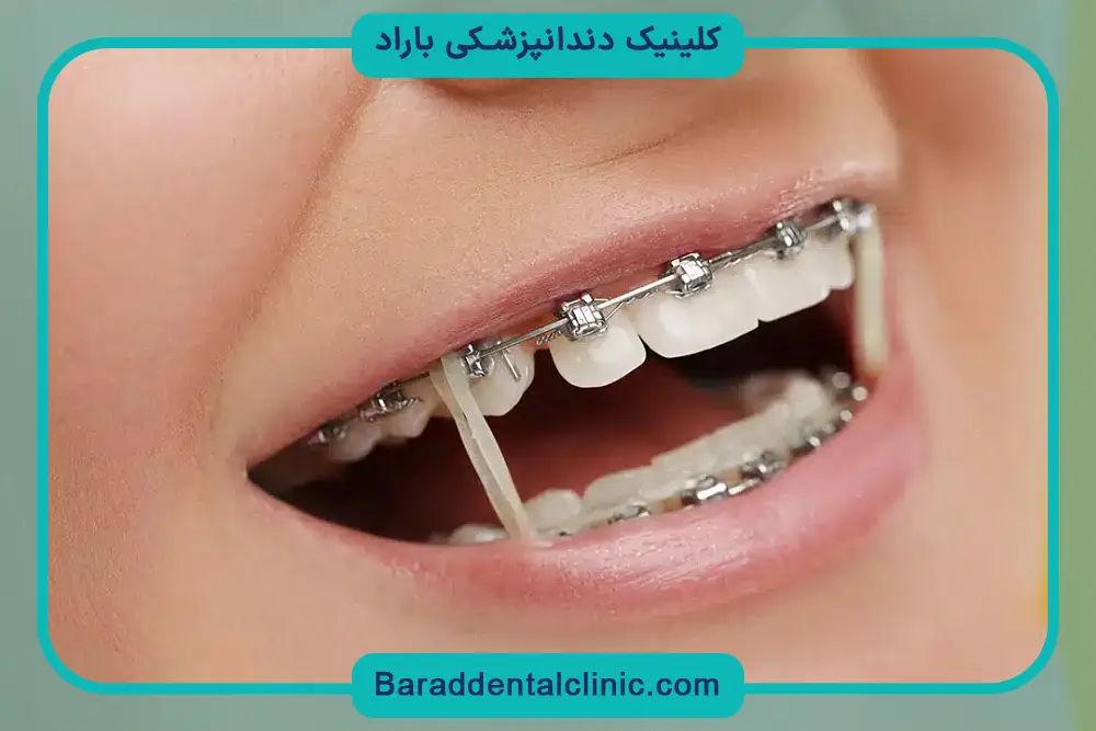 سیم کشی دندان تا چند سال طول میکشد؟ عوامل موثر