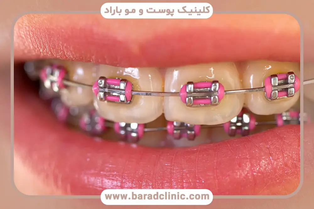 سیم کشی دندان تا چه سنی است؟ بررسی بزرگسالی