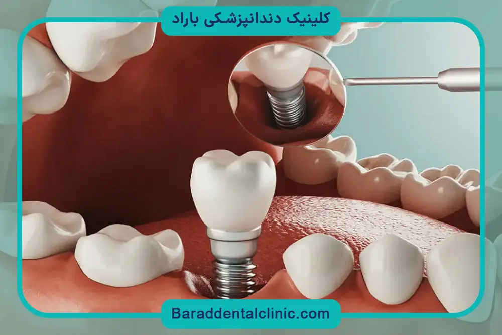 ایمپلنت دیجیتال چند روز طول میکشد؟ جلسه جراحی