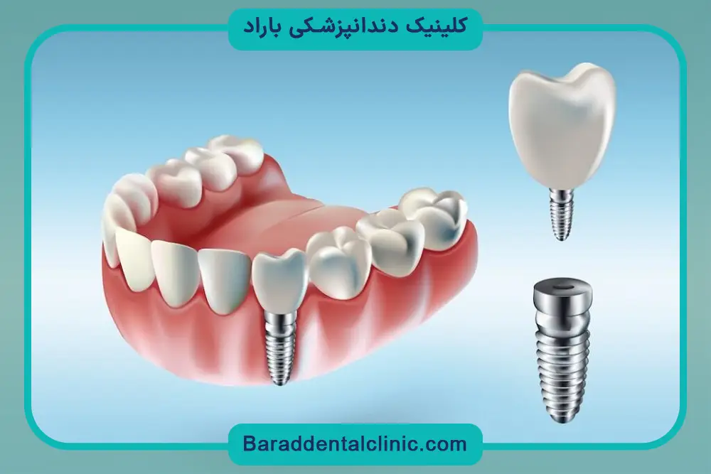 تفاوت ایمپلنت دیجیتال و معمولی در میزان درد