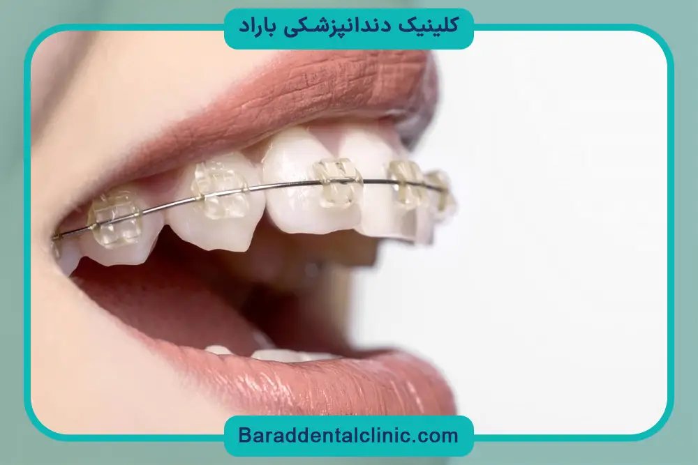 مراحل نصب براکت دندان نهفته