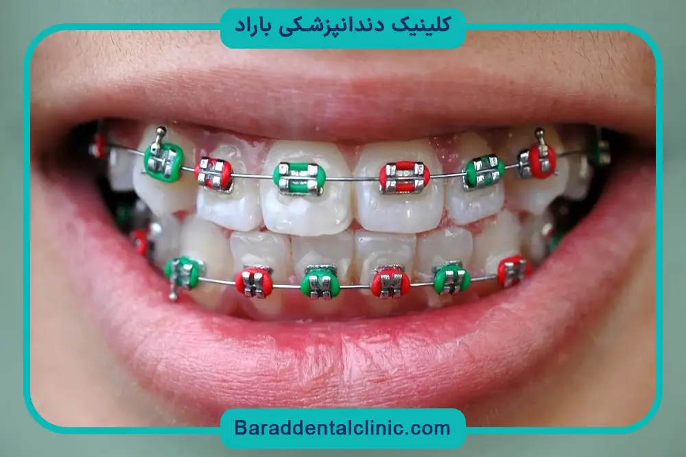 ظاهر سیم کشی در عکس سیم کشی دندان پسرانه 