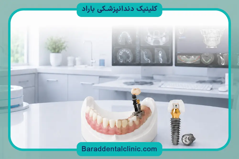 هزینه ایمپلنت دیجیتال پاسداران 