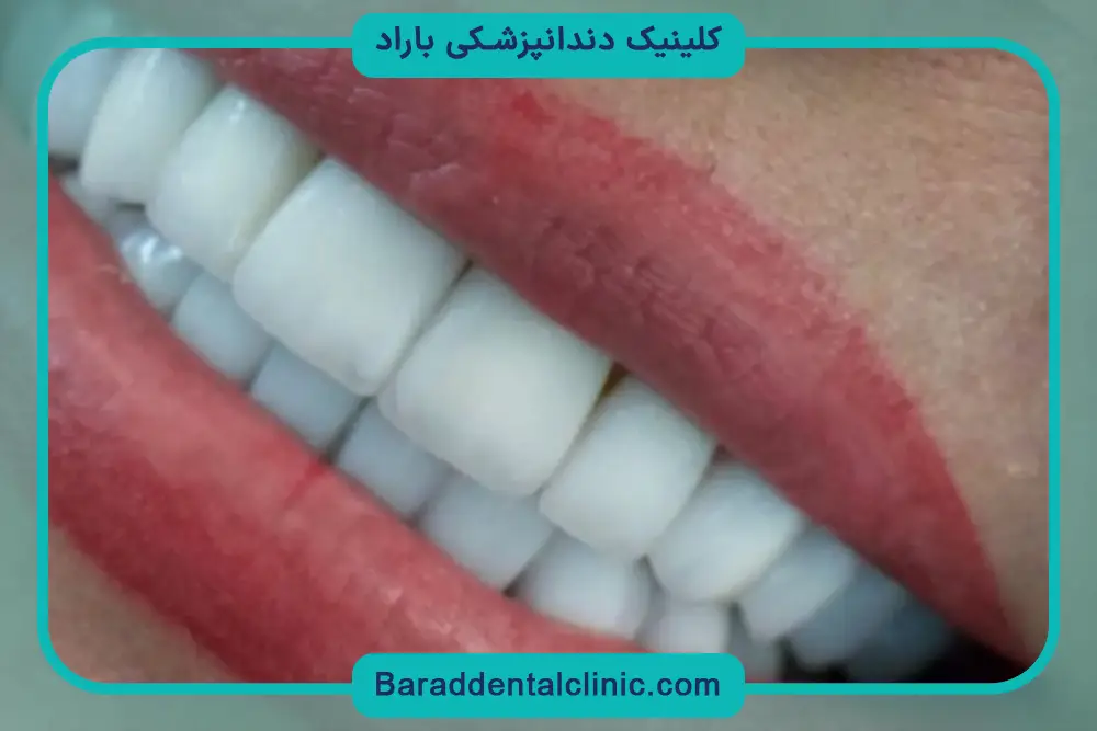 بررسی به صرفه بودن قیمت کامپوزیت ونیر ips 