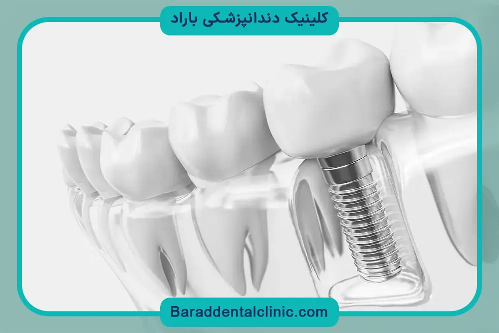هزینه ایمپلنت دیجیتال تهران