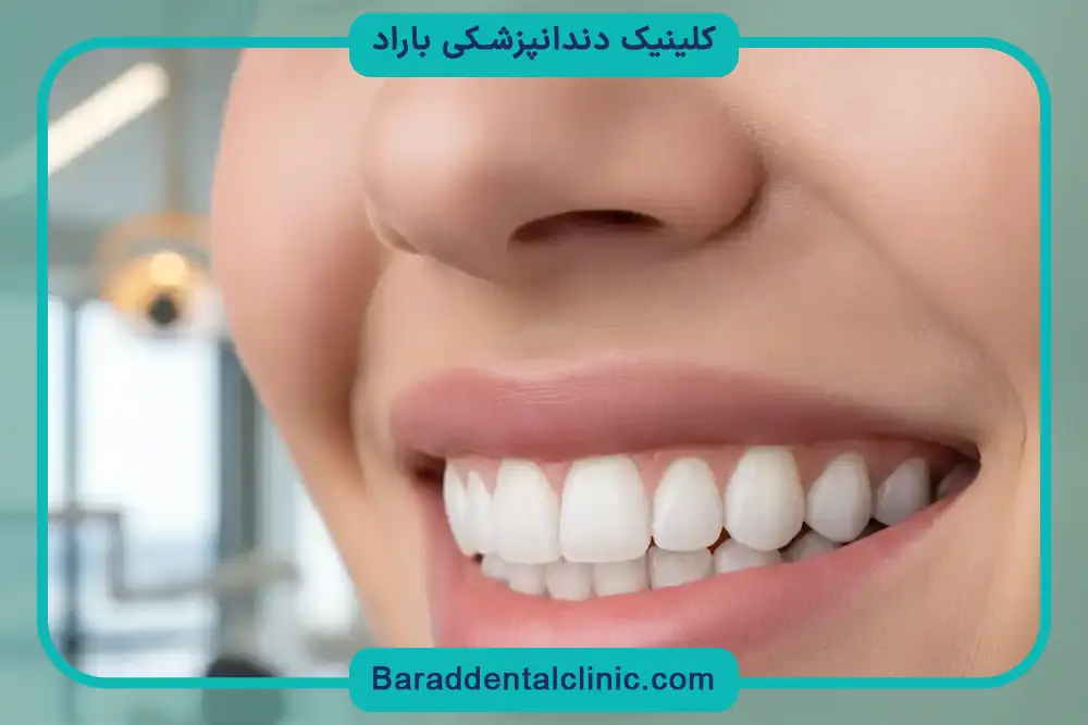 مقایسه انواع بهترین مارک کامپوزیت ونیر دندان 