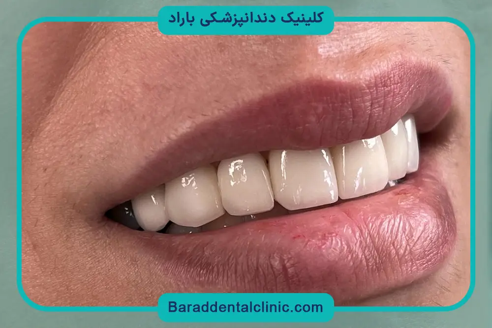 هزینه کامپوزیت تهران