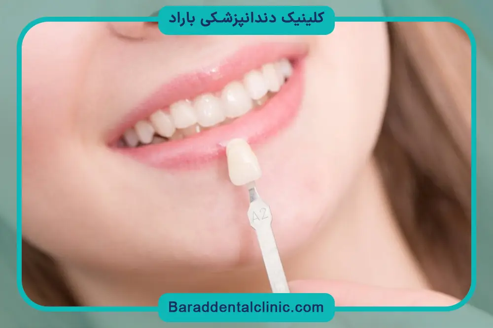 مراقبت‌های بعد از کامپوزیت قیطریه