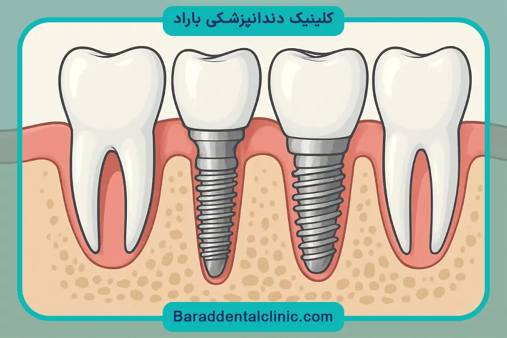 فرق ایمپلنت دیجیتال با پانچ از نظر میزان درد