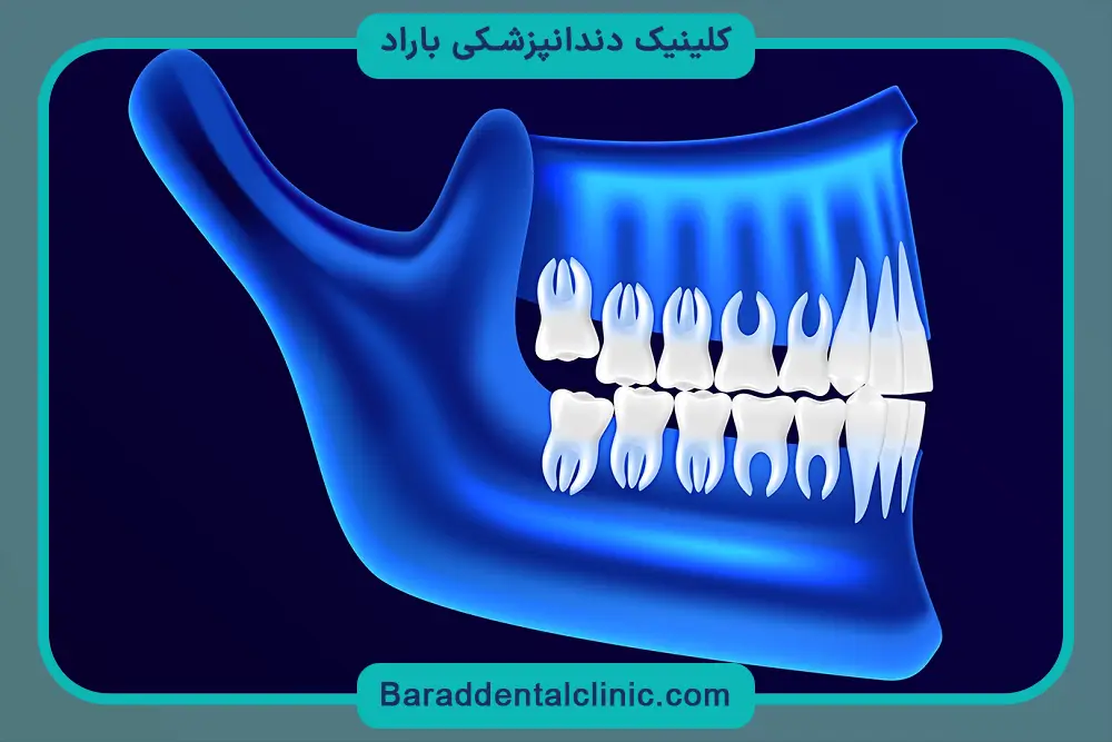 پروتز از انواع بازسازی دندان 