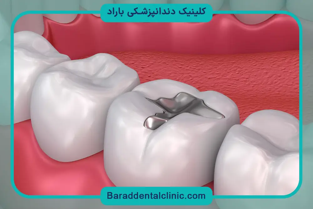 مراقبت‌های بعد از ترمیم و بازسازی دندان 