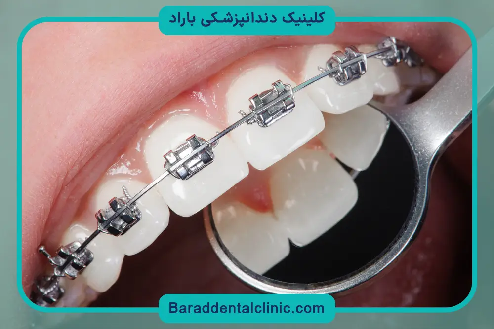 مزایا و معایب سیم پیچی دندان
