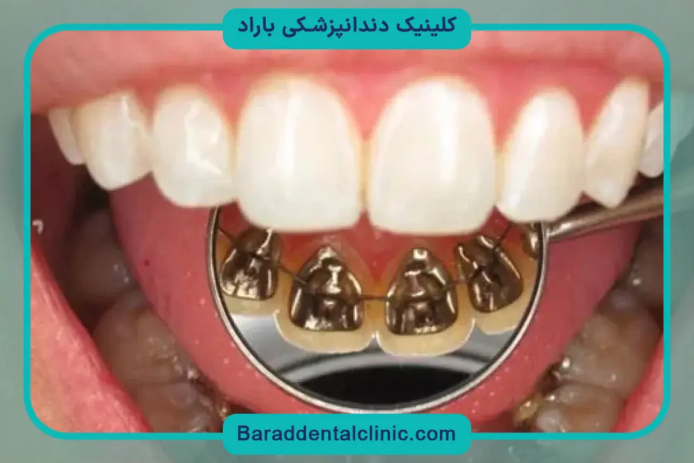 سیم کشی دندان تا چند سال طول میکشد؟ تفاوت کودکان، نوجوانان و بزرگسالان