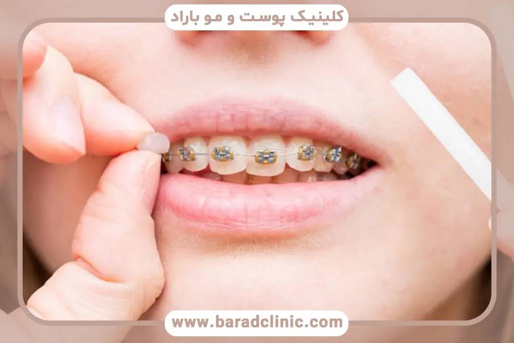 سیم کشی دندان تا چه سنی است؟ مزایا و محدودیت‌ها