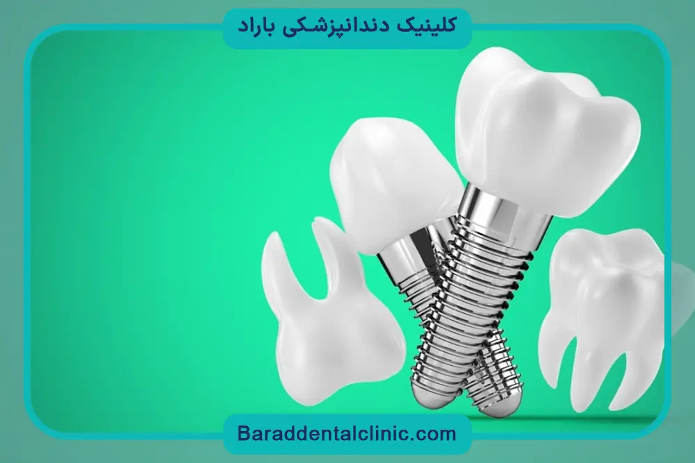 ایمپلنت دیجیتال چند روز طول میکشد؟ بررسی جلسه جراحی