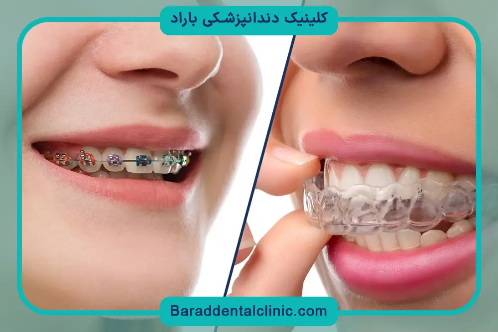 مراحل نصب براکت متحرک دندان