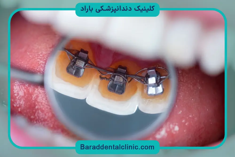 بررسی روند تغییرات در عکس سیم کشی دندان پسرانه 