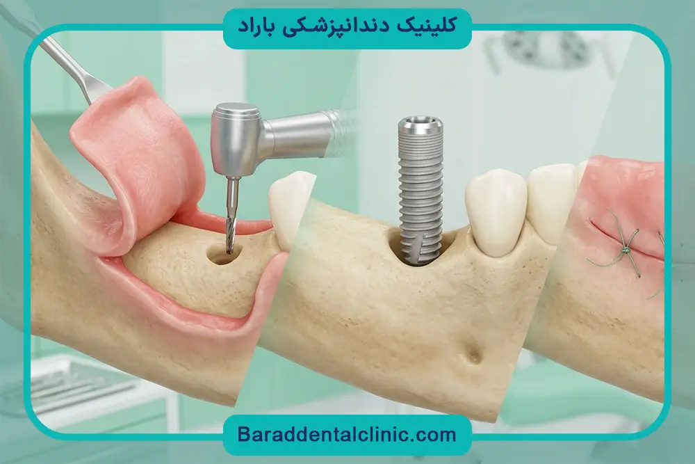 ایمپلنت فوری دیجیتال چیست؟