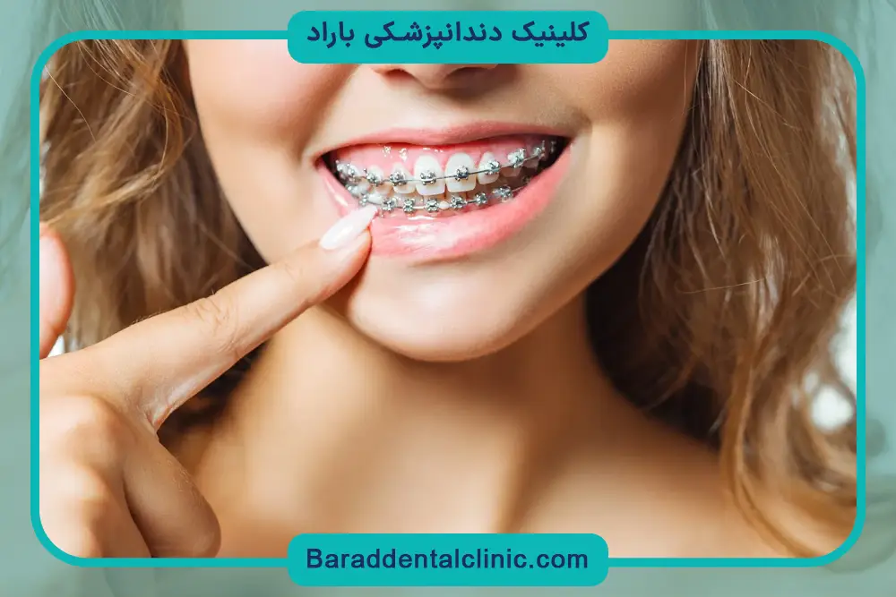 تاثیر سیم کشی دندان