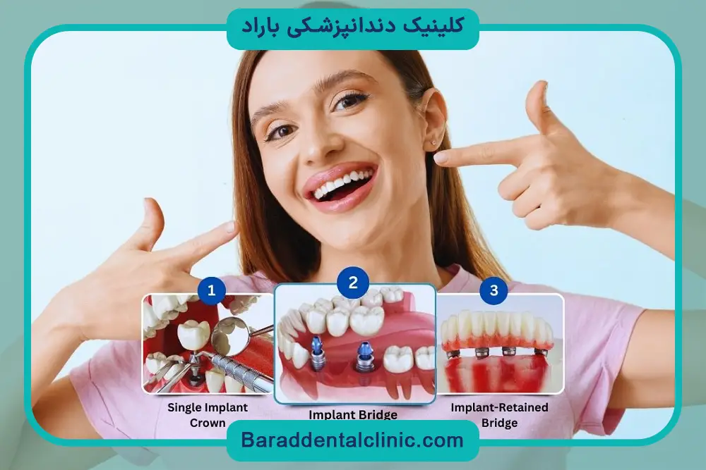 ایمپلنت دیجیتال چقدر طول میکشه؟