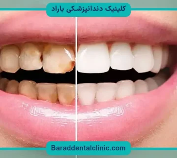 کامپوزیت ونیر چیست؟