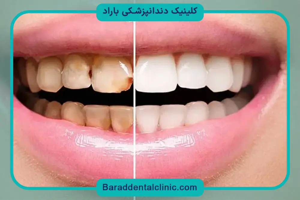 کامپوزیت ونیر چیست؟