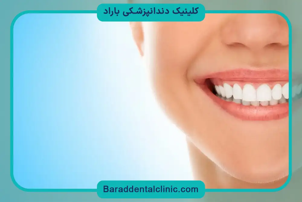 قیمت باندینگ دندان