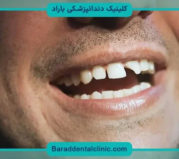 بازسازی دندان شکسته